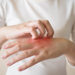 The Eczema Pill and Other Topical Eczema Treatments